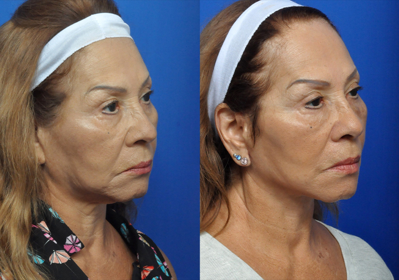 Neck Lift Journeys - Garcia Facial Plastic Surgery