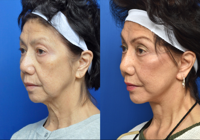 Neck Lift - Garcia Facial Plastic Surgery