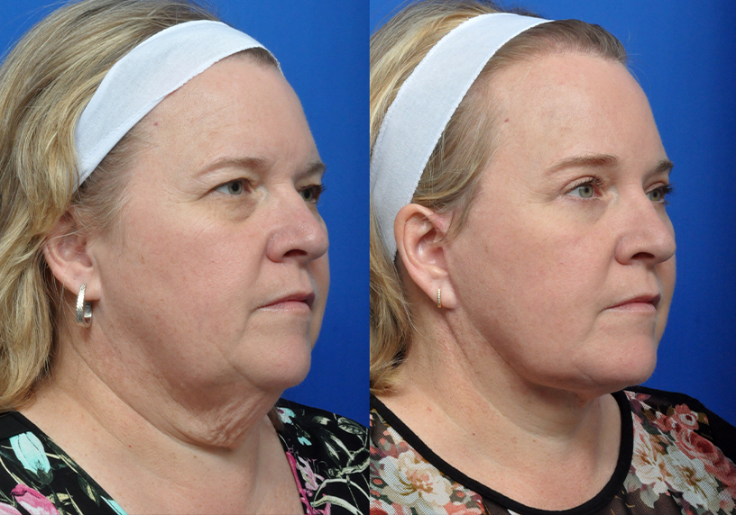 Neck Lift - Garcia Facial Plastic Surgery