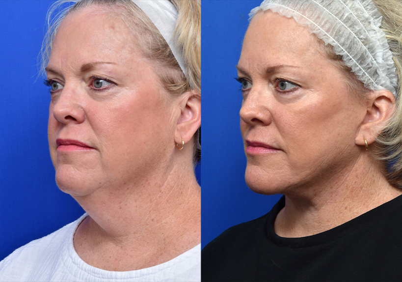 Neck Lift - Garcia Facial Plastic Surgery