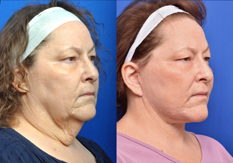 Neck Lift - Garcia Facial Plastic Surgery