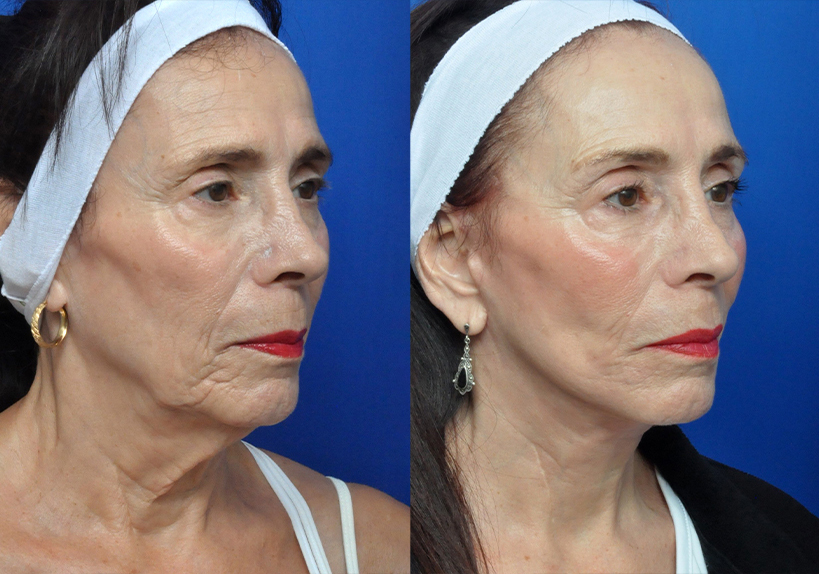 Neck Lift - Garcia Facial Plastic Surgery