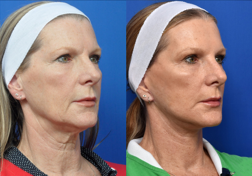 Neck Lift - Garcia Facial Plastic Surgery