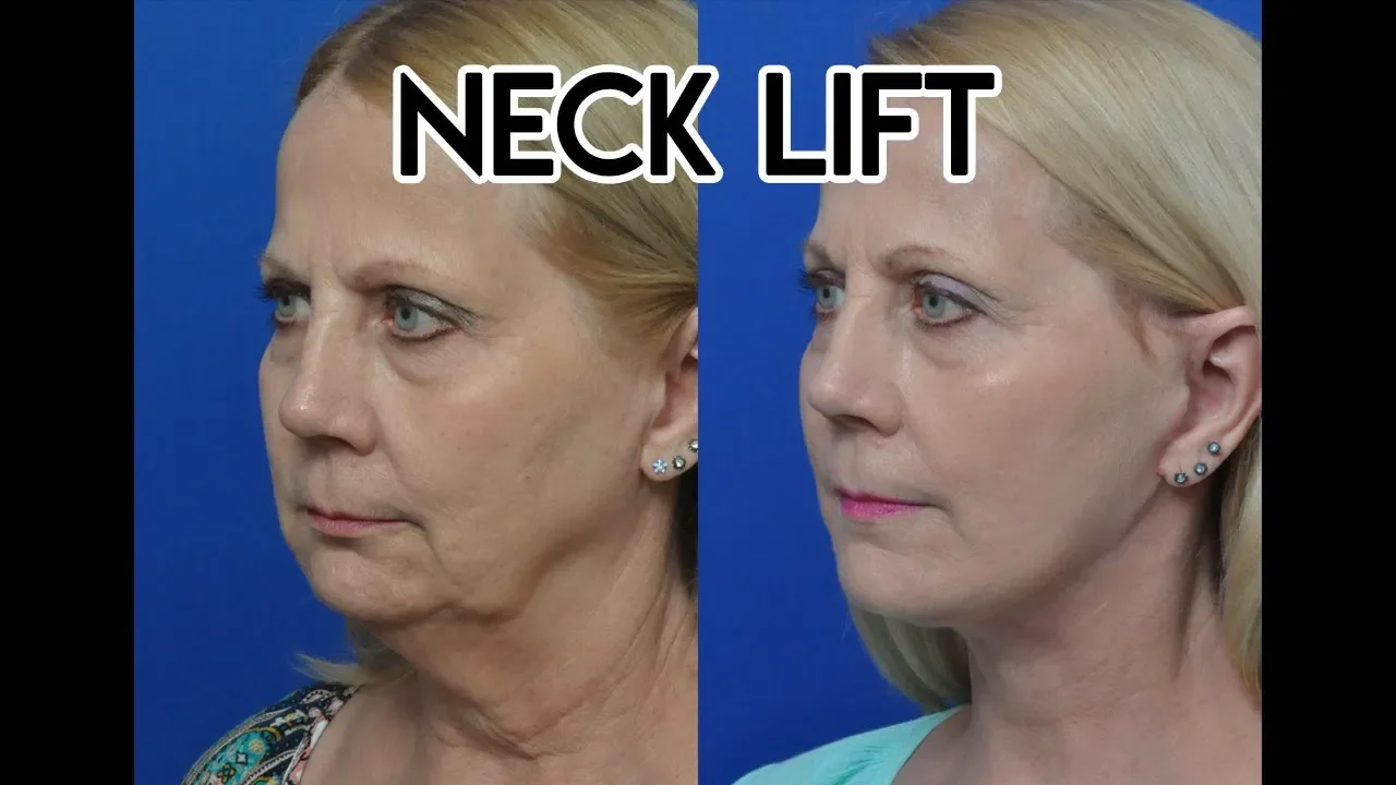 Neck Lift