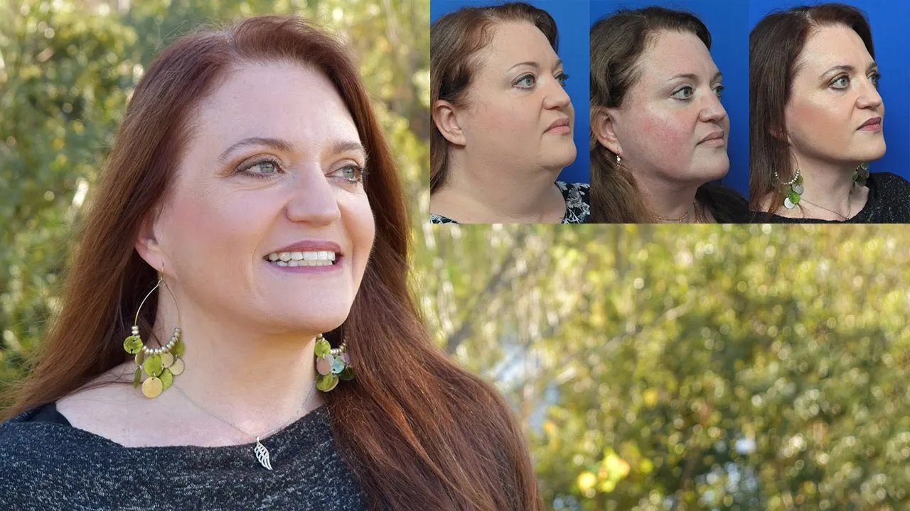 Facial Liposuction Surgery Jacksonville, FL Ponte Vedra Beach Facial