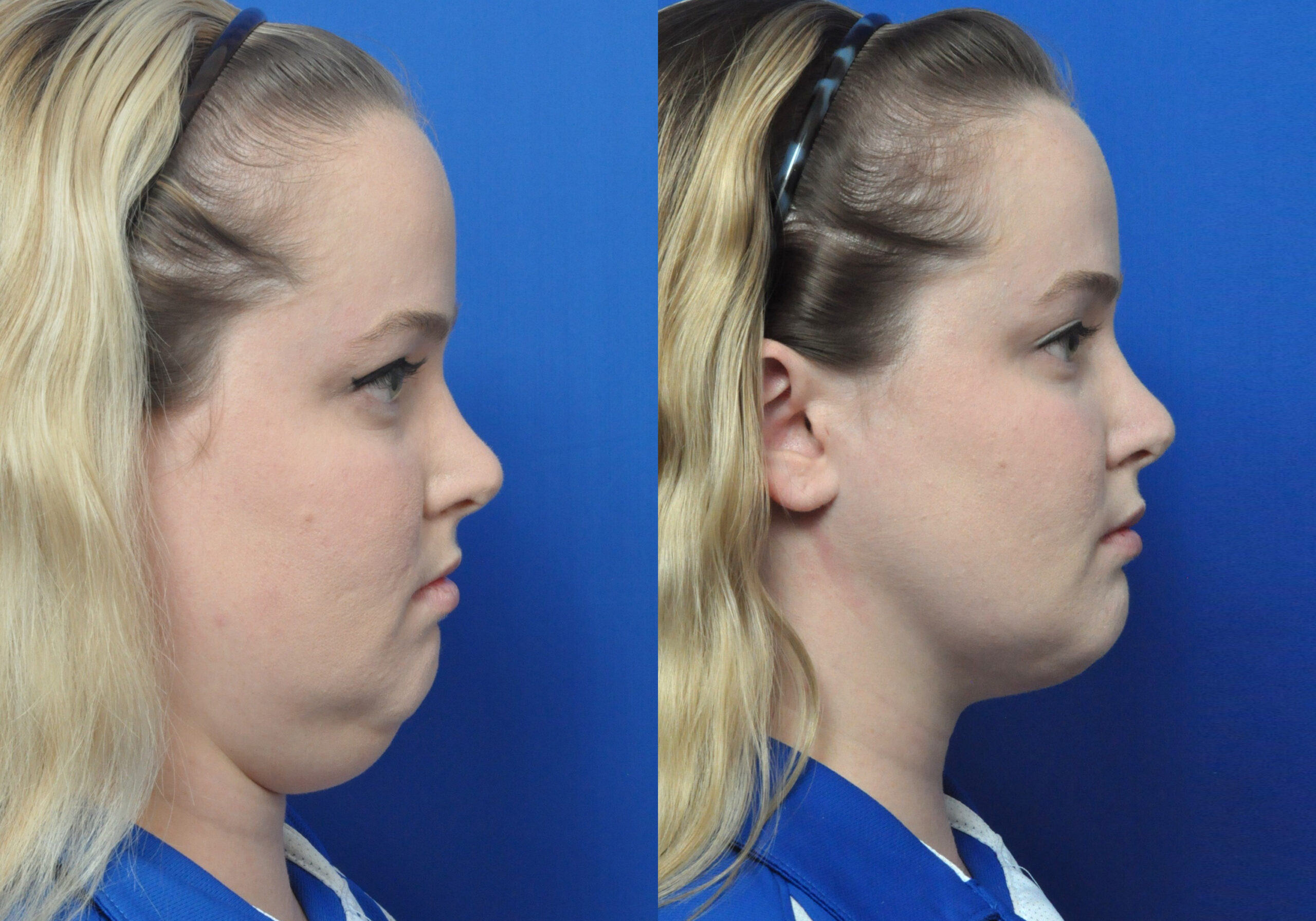 Facial Liposuction in Jacksonville, FL