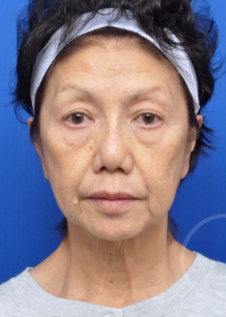 Facelift Before and After Pictures Jacksonville, FL