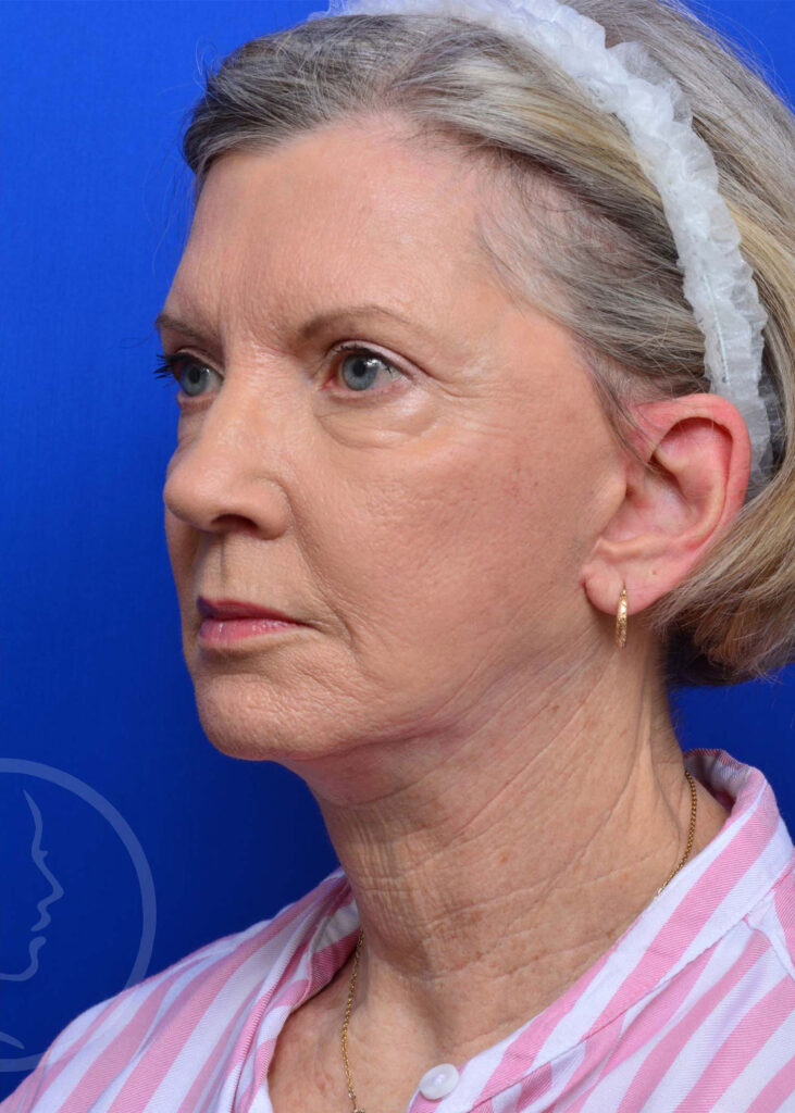 Facelift Before and After Pictures Jacksonville, FL