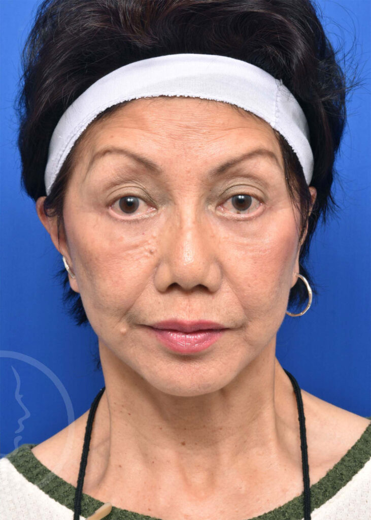 Facelift Before and After Pictures Jacksonville, FL