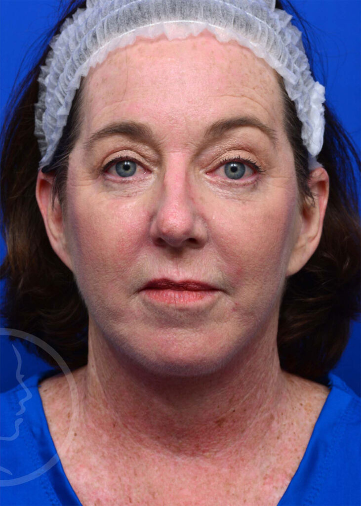 Facelift Before and After Pictures Jacksonville, FL