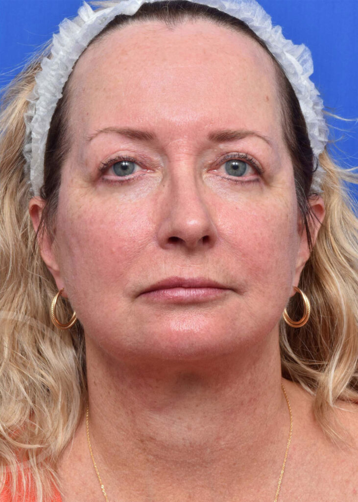 Facelift Before and After Pictures Jacksonville, FL