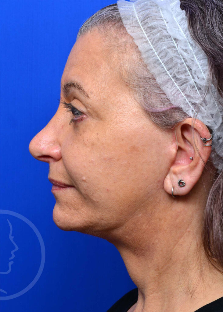 Facelift Before and After Pictures Jacksonville, FL