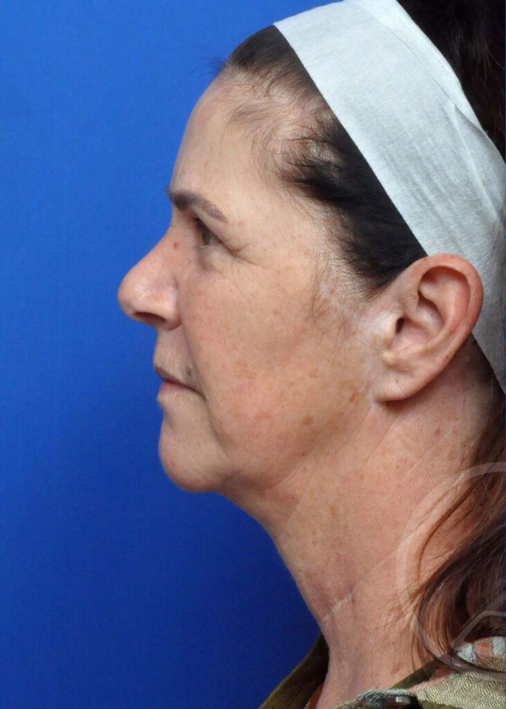 Facelift Before and After Pictures Jacksonville, FL