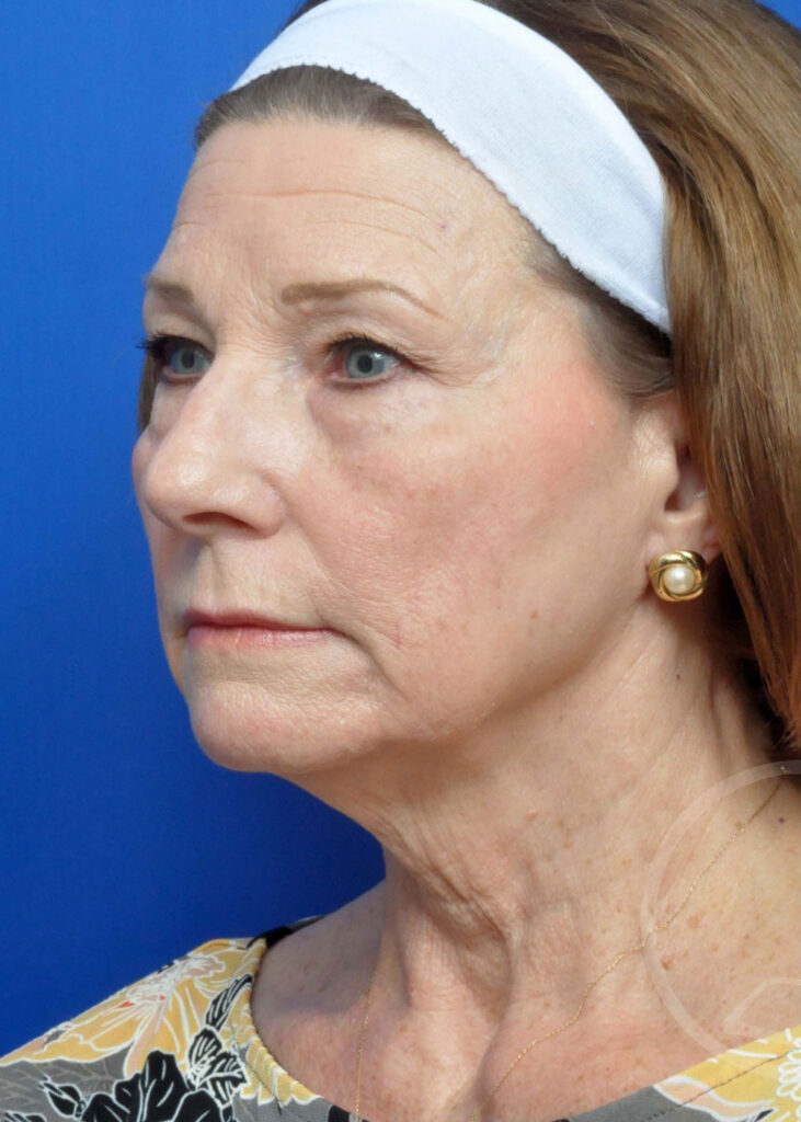 Facelift Before and After Pictures Jacksonville, FL