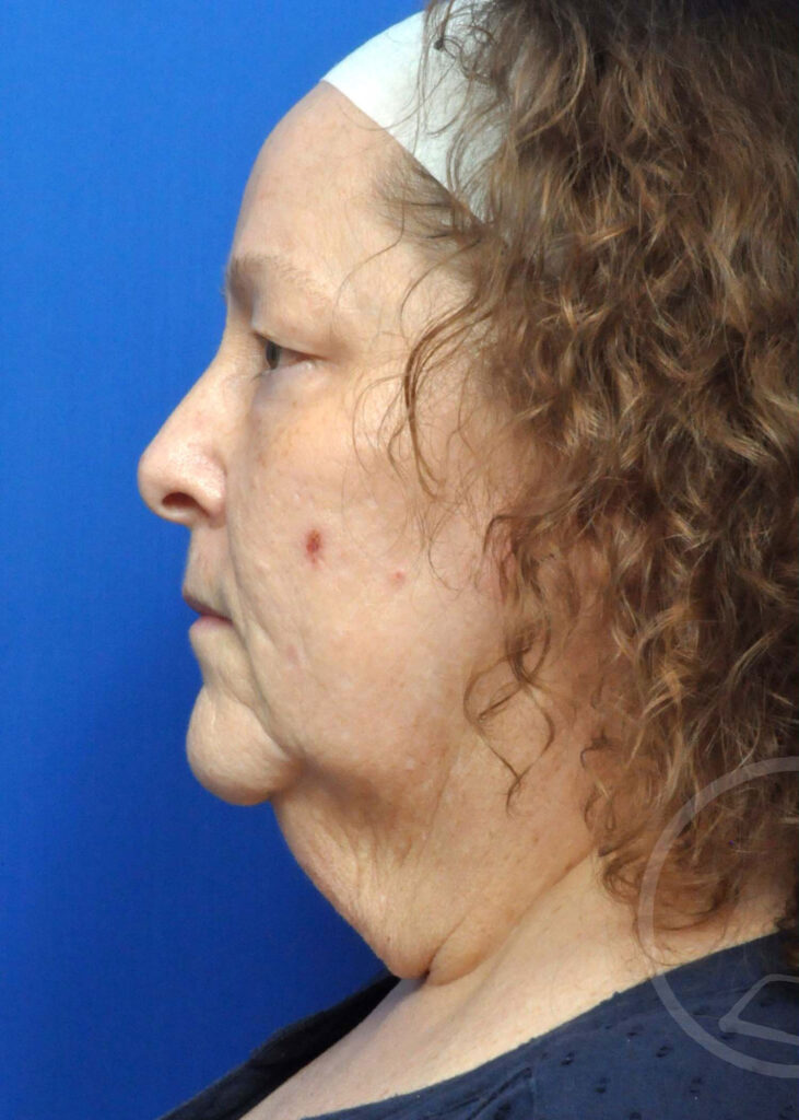 Facelift Before and After Pictures Jacksonville, FL