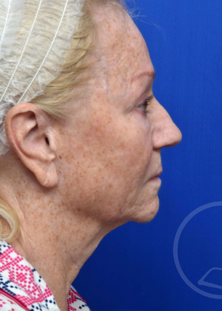 Facelift Before and After Pictures Jacksonville, FL