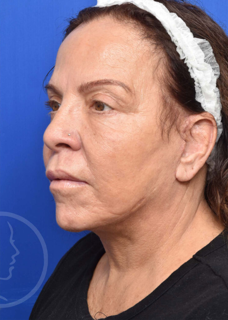 Facelift Before and After Pictures Jacksonville, FL