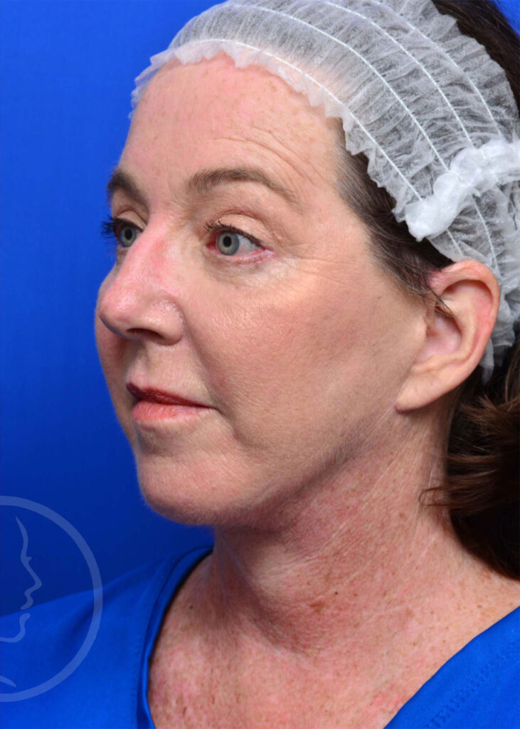 Facelift Before and After Pictures Jacksonville, FL