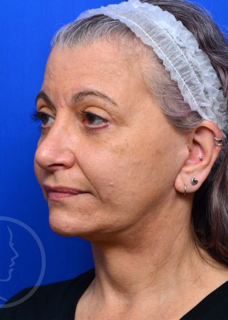 Facelift Before and After Pictures Jacksonville, FL