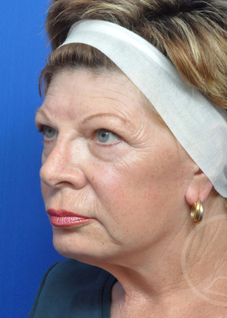 Facelift Before and After Pictures Jacksonville, FL