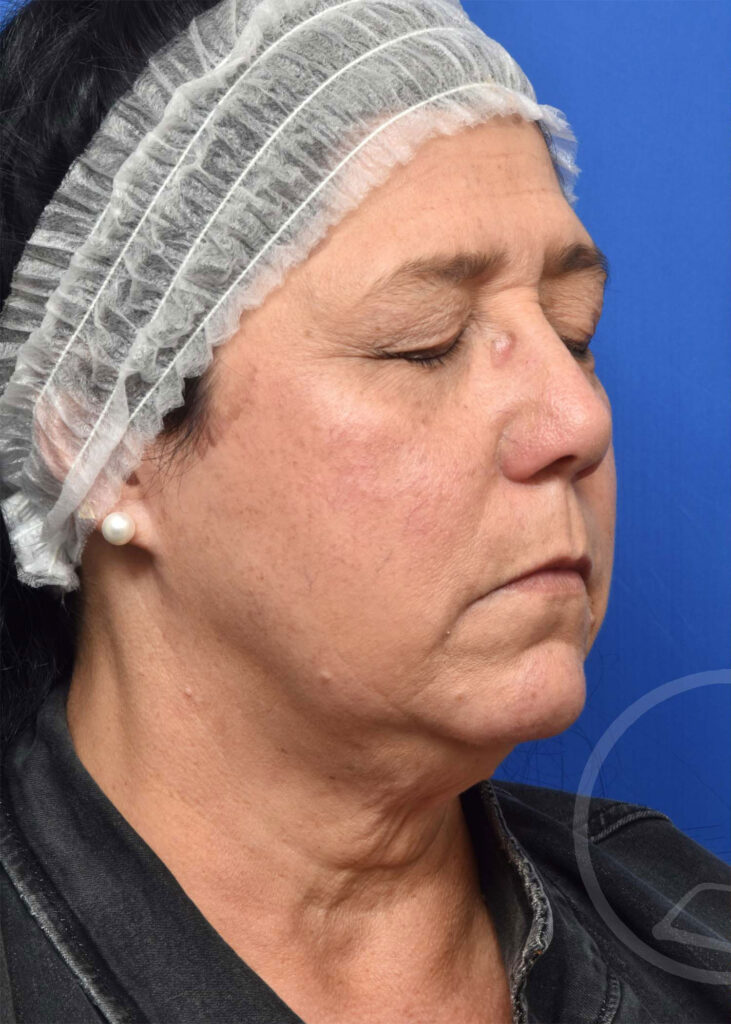 Facelift Before and After Pictures Jacksonville, FL