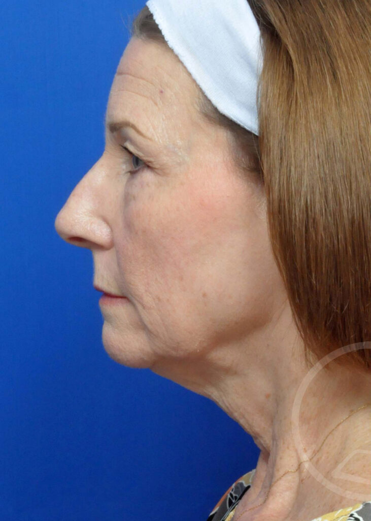 Facelift Before and After Pictures Jacksonville, FL