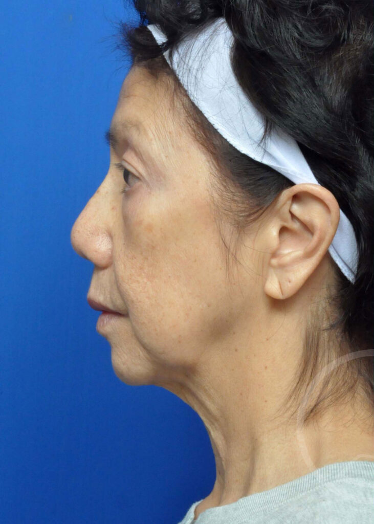 Facelift Before and After Pictures Jacksonville, FL