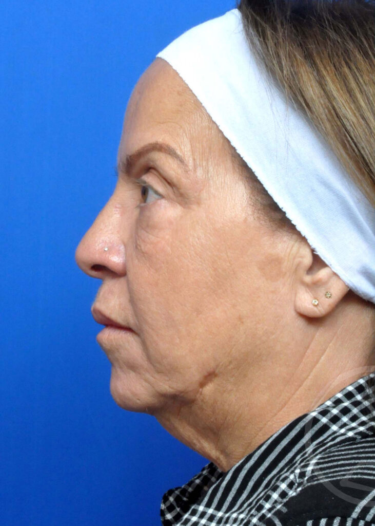 Facelift Before and After Pictures Jacksonville, FL