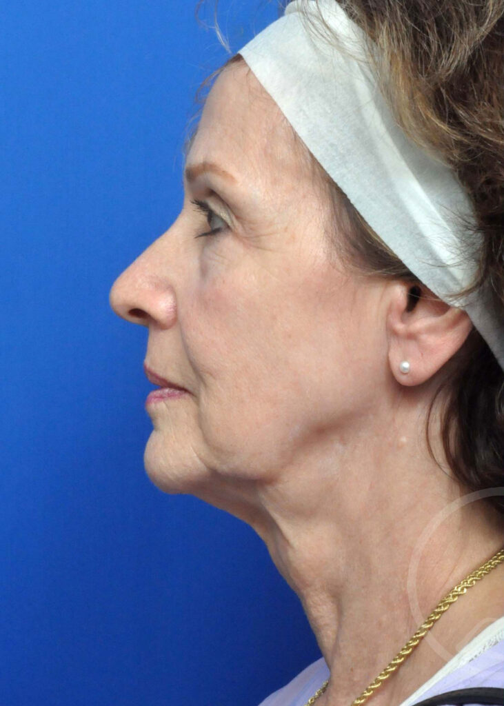 Facelift Before and After Pictures Jacksonville, FL