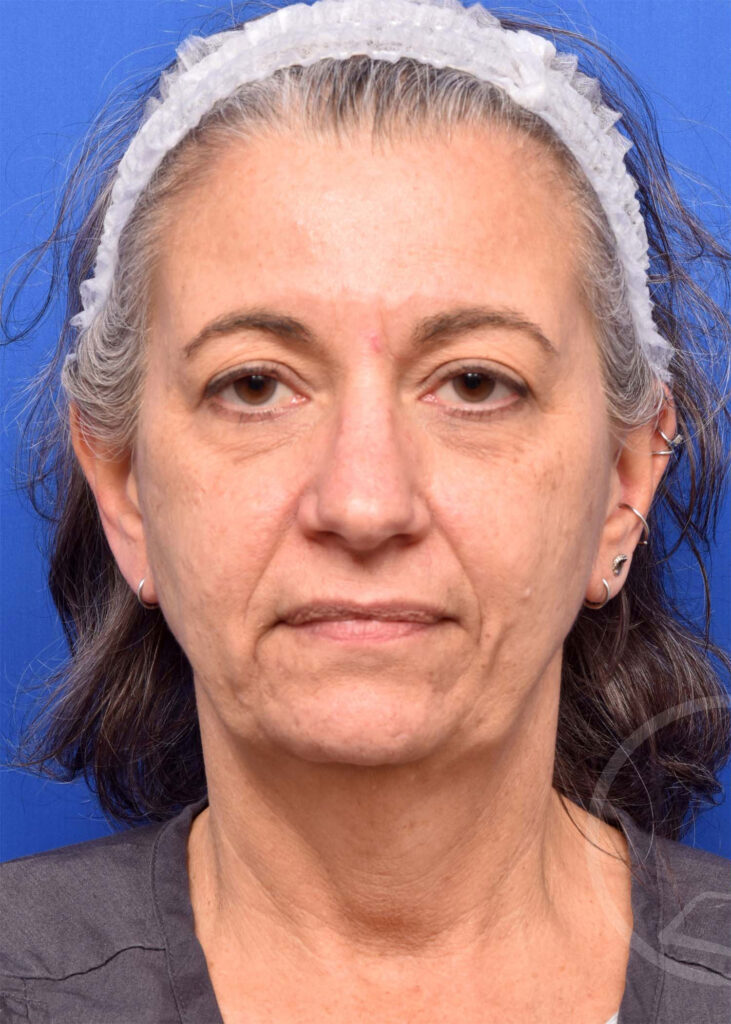 Facelift Before and After Pictures Jacksonville, FL