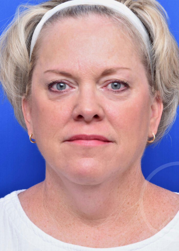 Facelift Before and After Pictures Jacksonville, FL