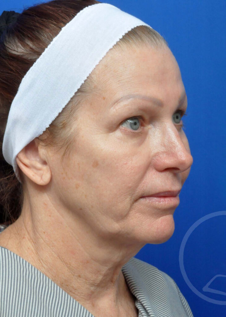 Facelift Before and After Pictures Jacksonville, FL