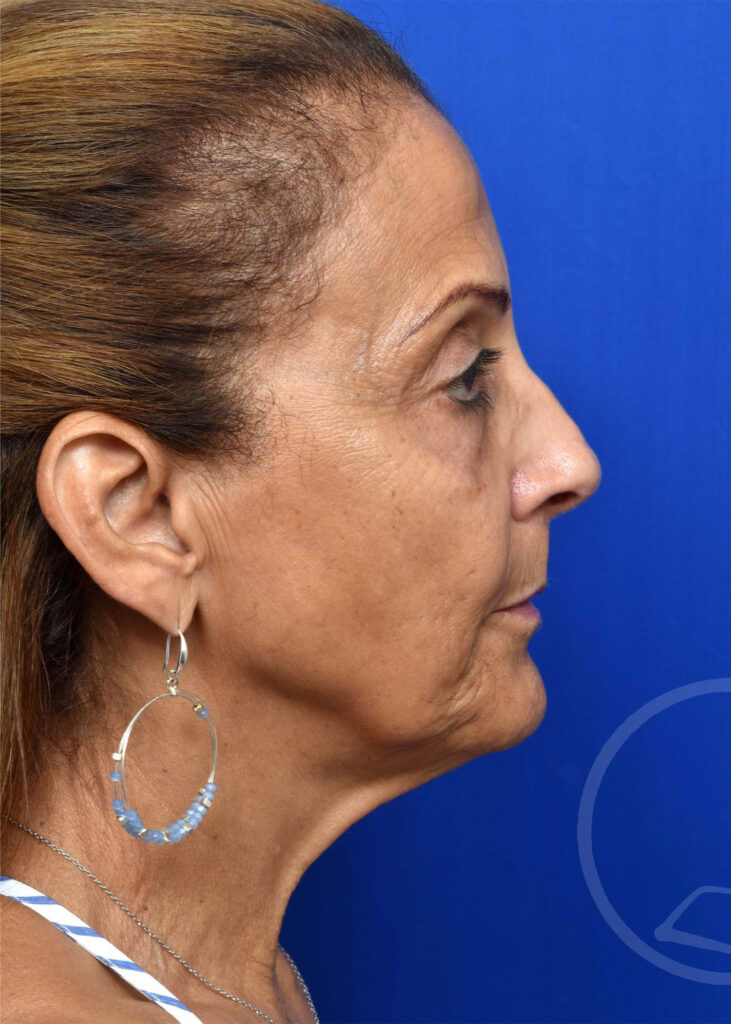 Facelift Before and After Pictures Jacksonville, FL