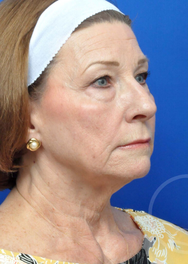 Facelift Before and After Pictures Jacksonville, FL