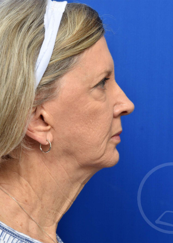 Facelift Before and After Pictures Jacksonville, FL