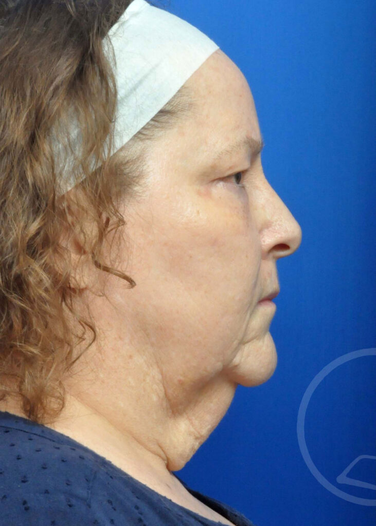 Facelift Before and After Pictures Jacksonville, FL