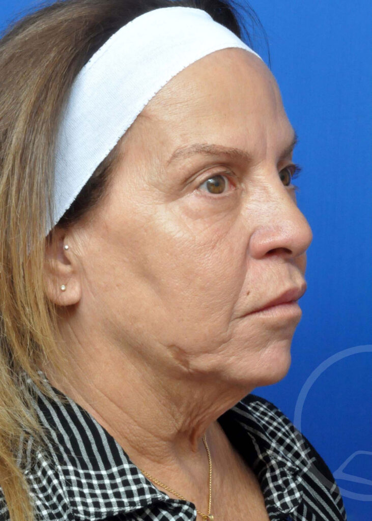 Facelift Before and After Pictures Jacksonville, FL