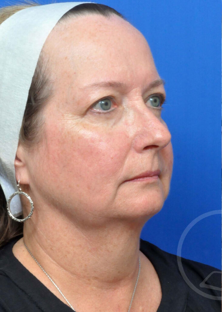 Facelift Before and After Pictures Jacksonville, FL