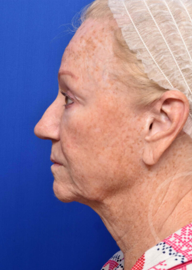 Facelift Before and After Pictures Jacksonville, FL