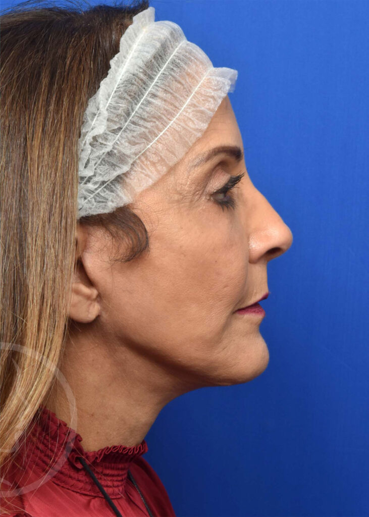 Facelift Before and After Pictures Jacksonville, FL