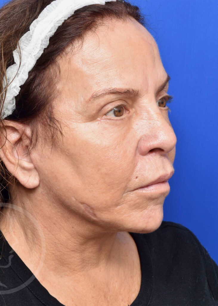 Facelift Before and After Pictures Jacksonville, FL