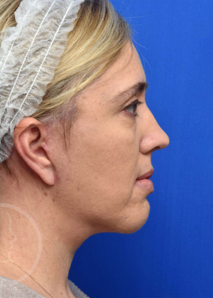 Facelift Before and After Pictures Jacksonville, FL