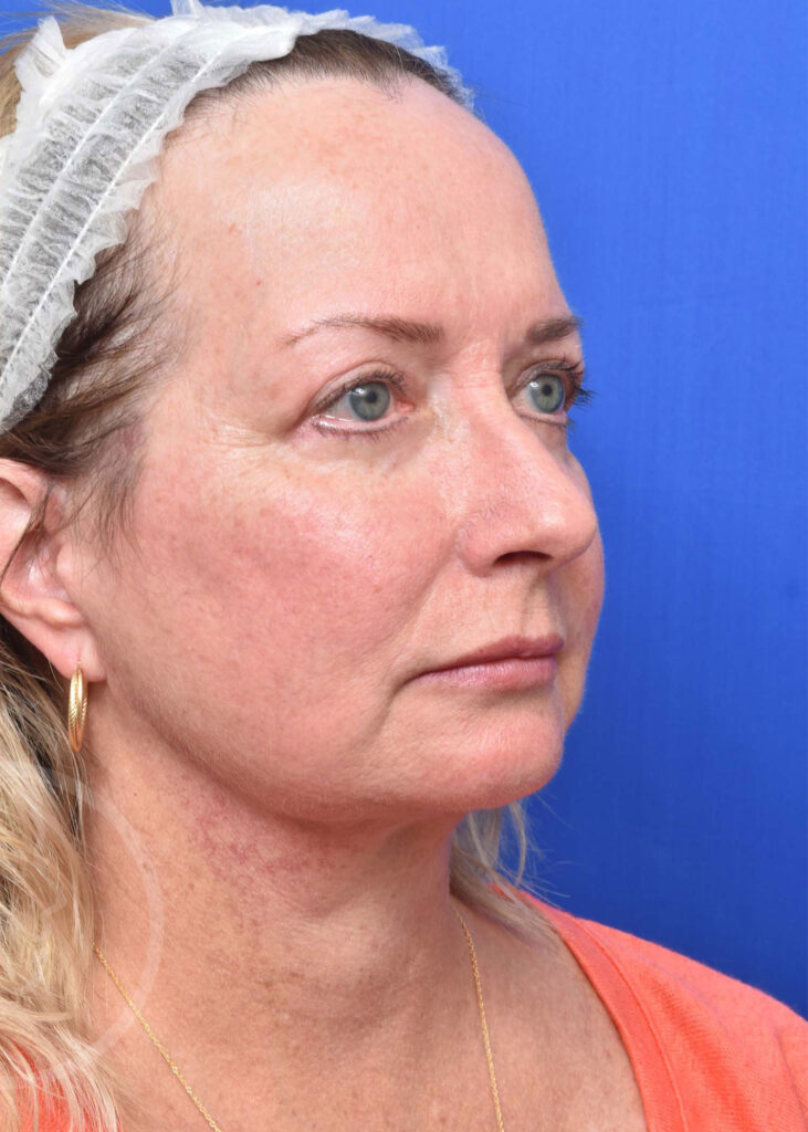 Facelift Before and After Pictures Jacksonville, FL