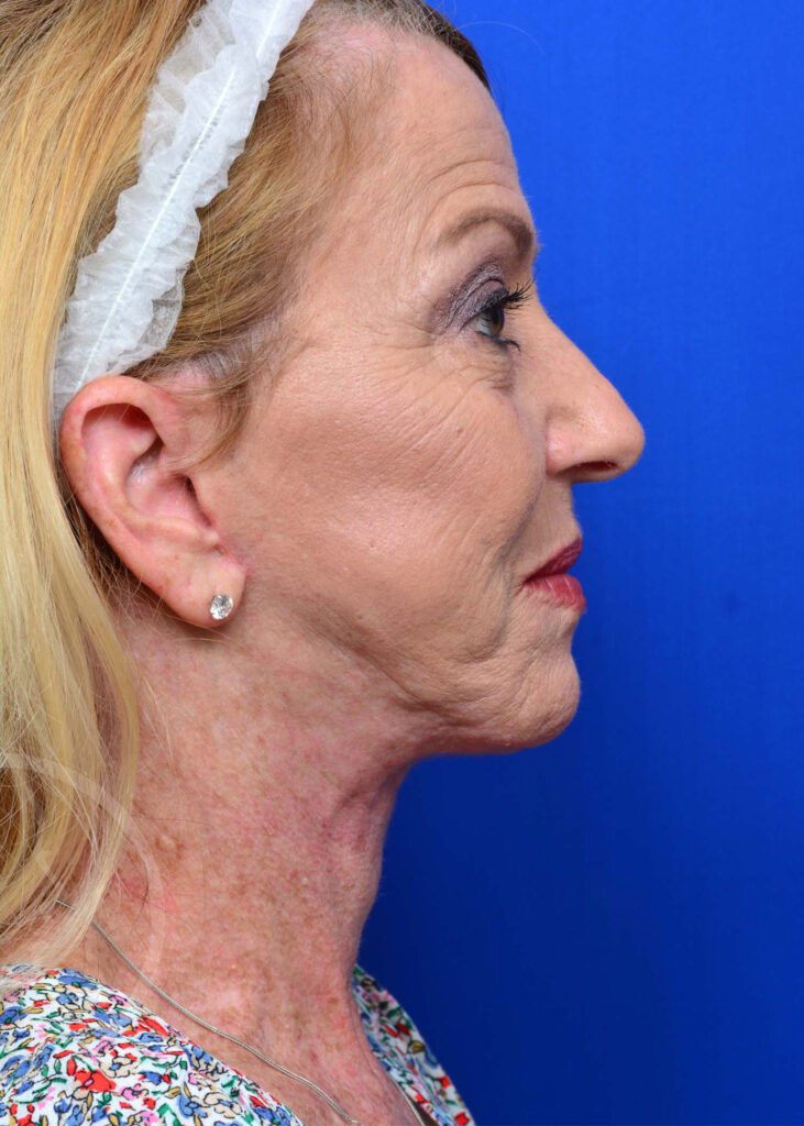 Facelift Before and After Pictures Jacksonville, FL