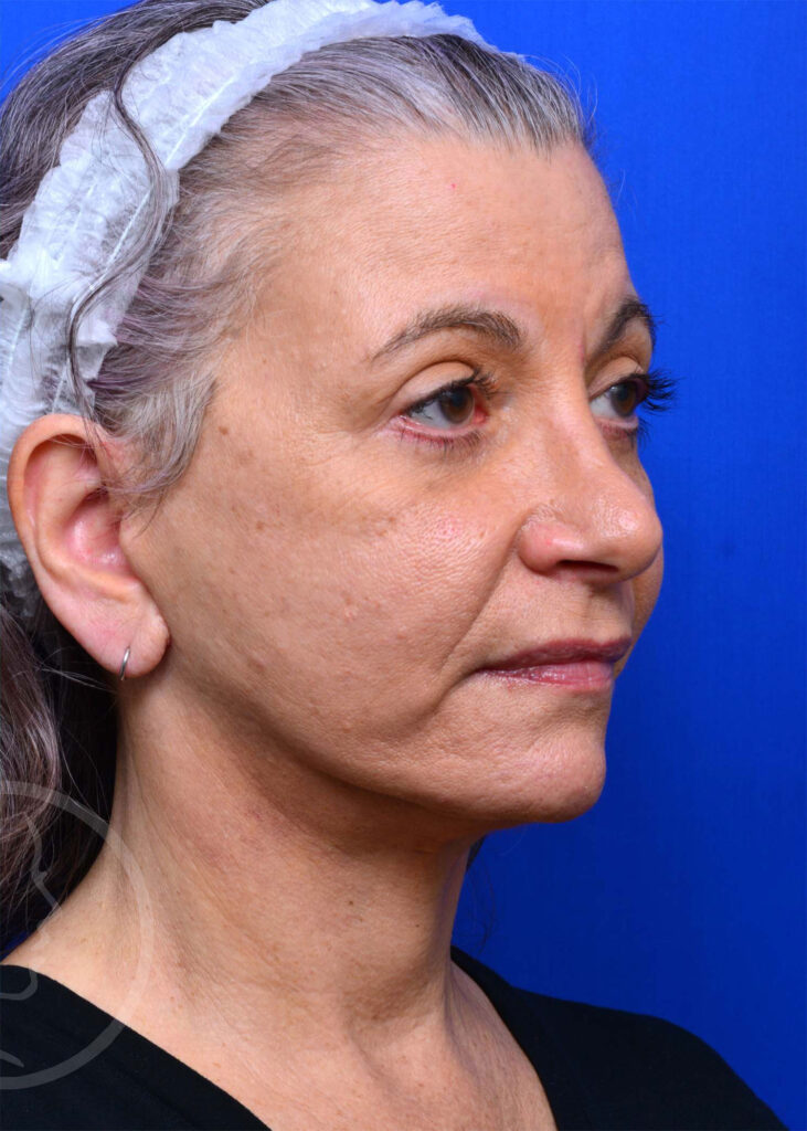 Facelift Before and After Pictures Jacksonville, FL