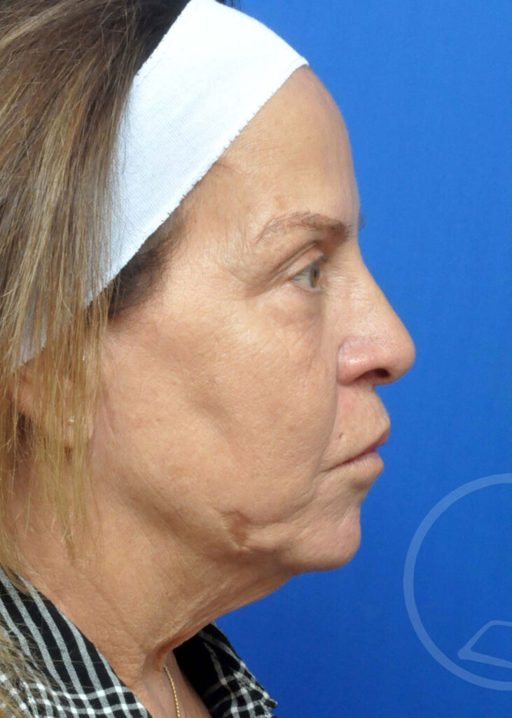 Facelift Before and After Pictures Jacksonville, FL