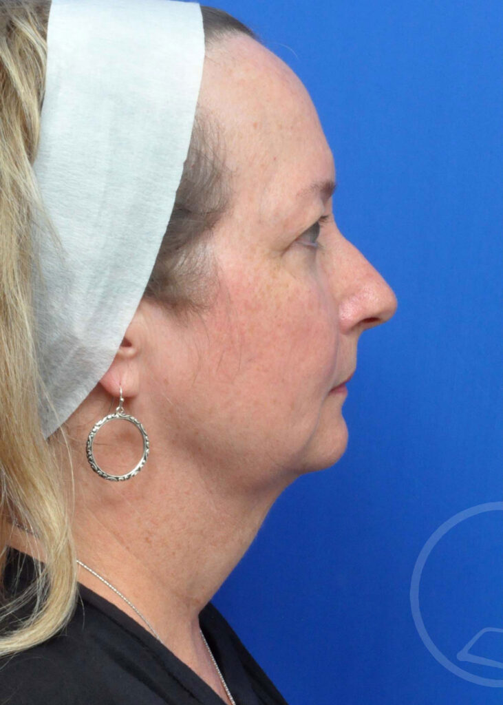 Facelift Before and After Pictures Jacksonville, FL