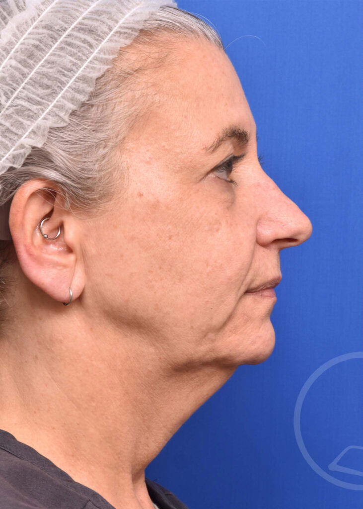 Facelift Before and After Pictures Jacksonville, FL