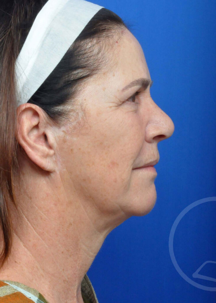 Facelift Before and After Pictures Jacksonville, FL