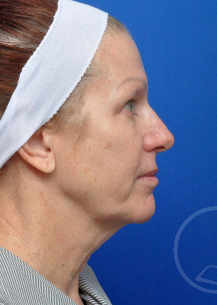 Facelift Before and After Pictures Jacksonville, FL